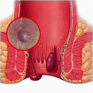 aimoroidopatheia