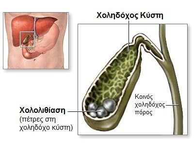 Χολολιθίαση - Πρέπει να χειρουργείται;