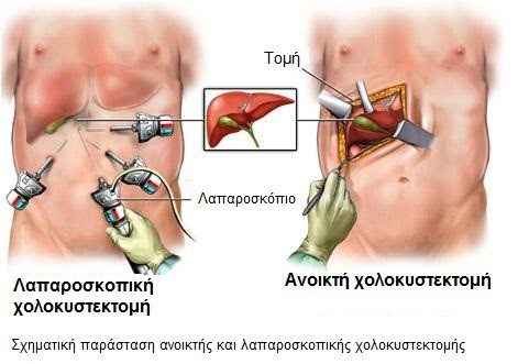 Λαπαροσκοπική Χολοκυστεκτομή