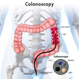 colonscopy 1